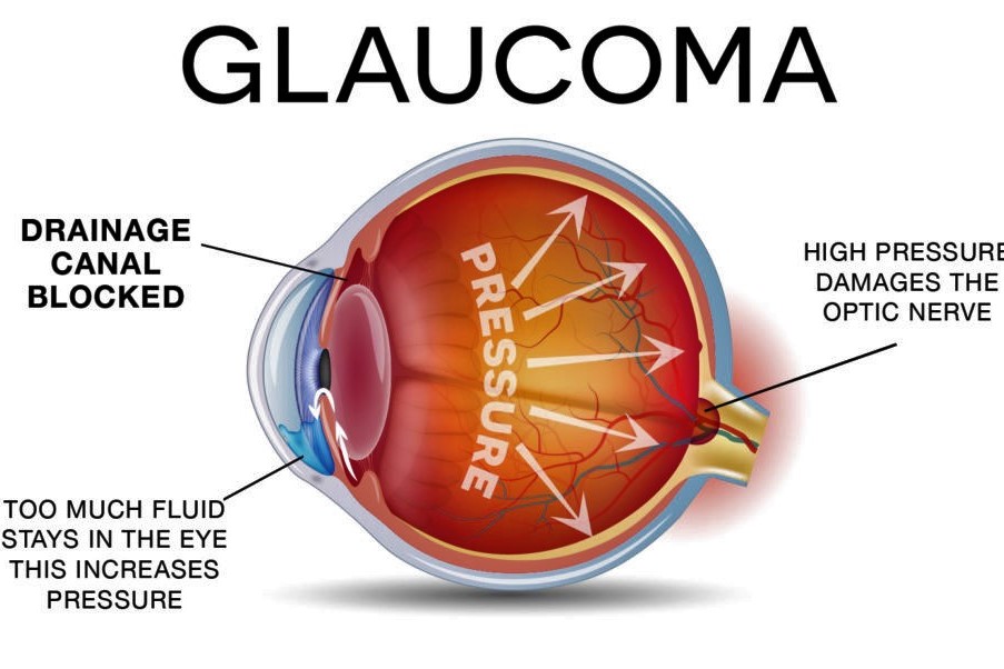 congenital glaucoma diagram