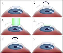 Refractive Laser Surgery